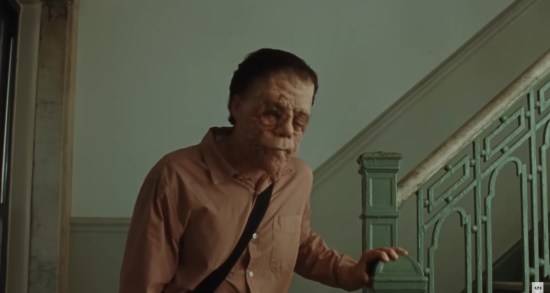 Man with neurofibromatosis pauses in an apartment building staircase.